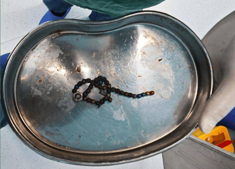 整整37顆！云南4歲孩子身體里取出……醫(yī)生緊急提醒！